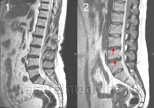Mugurkaula osteohondroze
